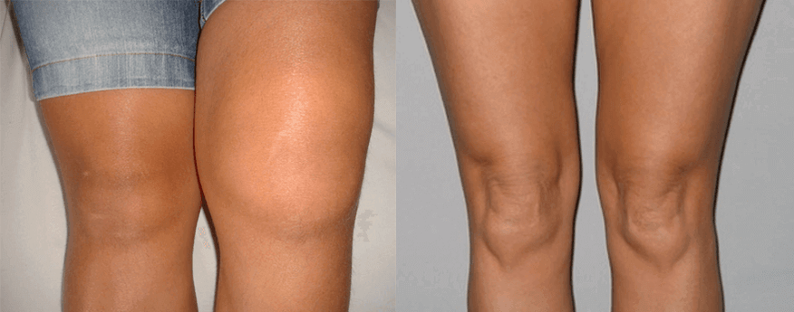 Expérience de l'utilisation des capsules d'huile de cannabis avant et après utilisation d'Eva